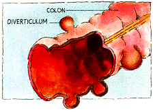 diverticulum